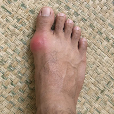 JEMPOL BENGKAK